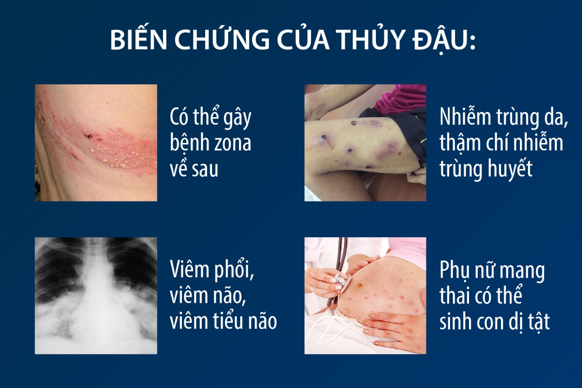 Cách nhận biết về bệnh Thủy đậu và phương pháp điều trị