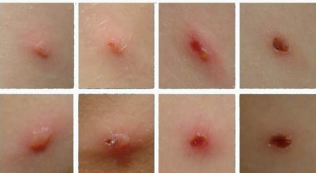 Bệnh thủy đậu - Những điều cần biết
