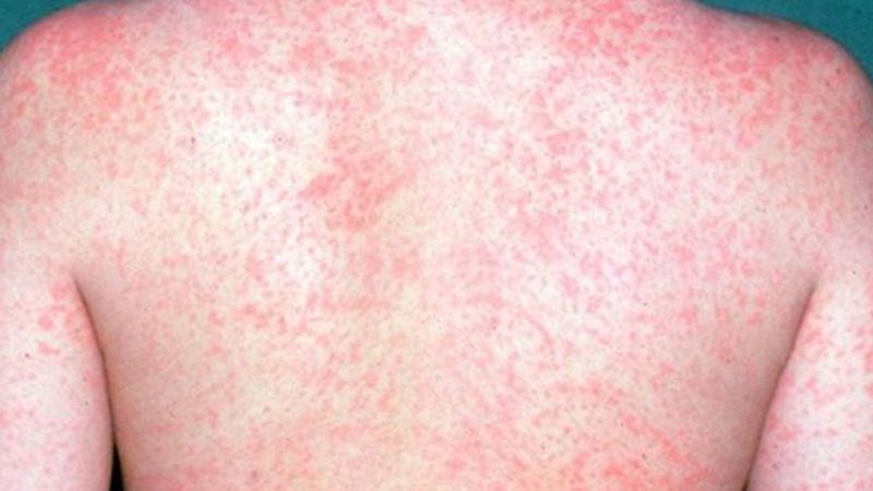 Nhận biết sớm các dấu hiệu bệnh sởi ở trẻ em?