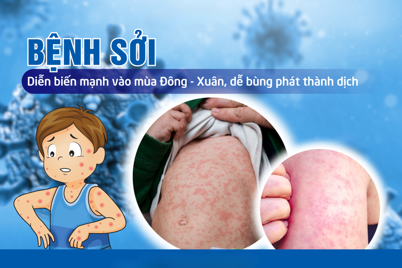 Bệnh sởi và cách phòng tránh bệnh sởi hiệu quả nhất