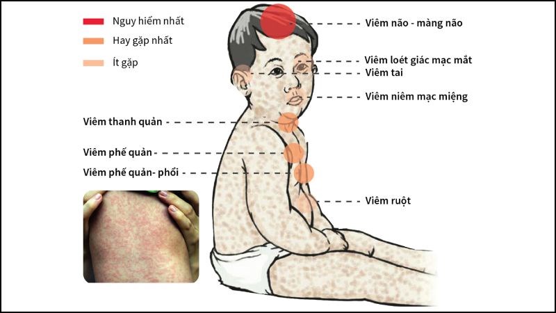 Nhận biết sớm các dấu hiệu bệnh sởi ở trẻ em?