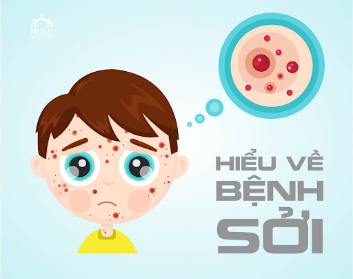 Bệnh Sởi - Những điều cần biết