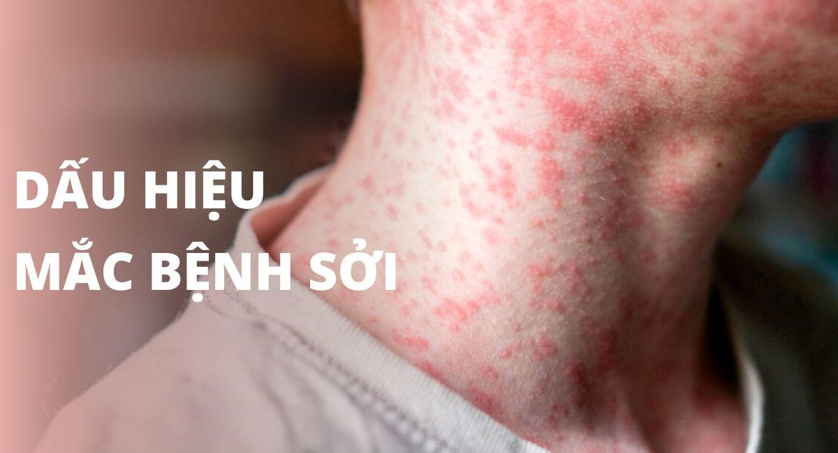 Nhận biết sớm các dấu hiệu bệnh sởi ở trẻ em?