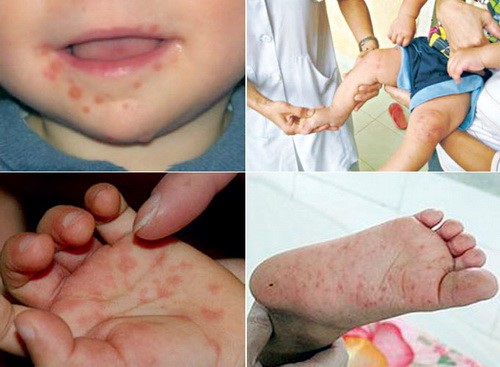 Bệnh tay chân miệng - Hiểu rõ để bảo vệ con