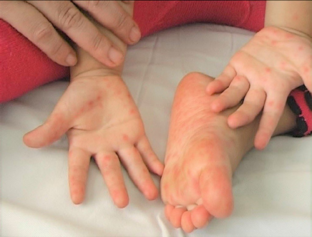 Bệnh tay chân miệng - Hiểu rõ để bảo vệ con