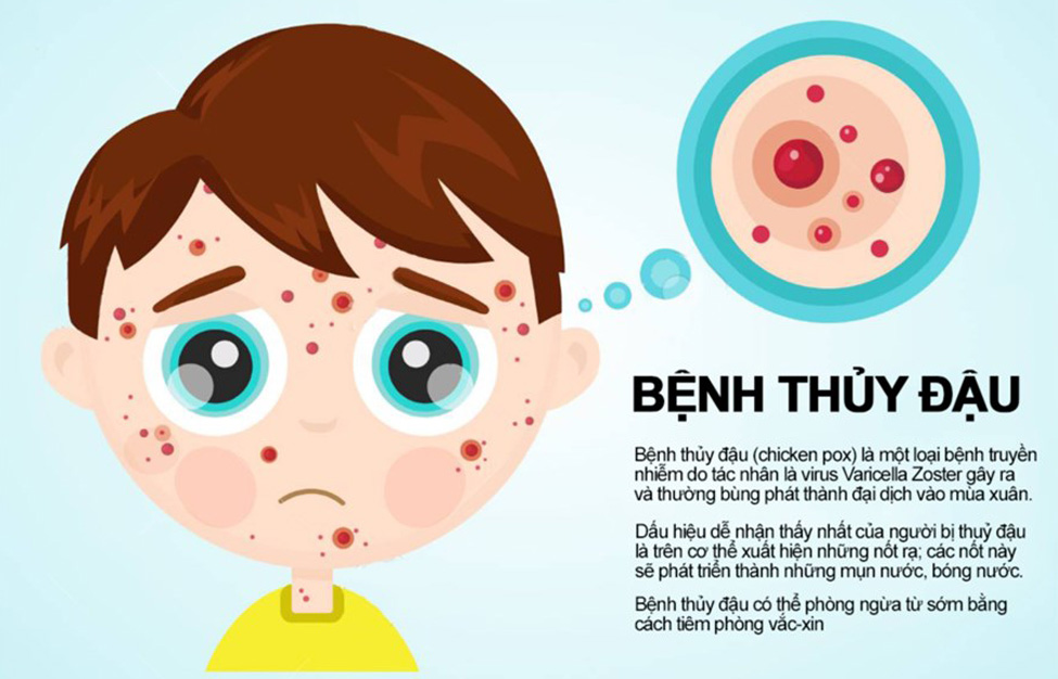 Bệnh thủy đậu - Những điều cần biết