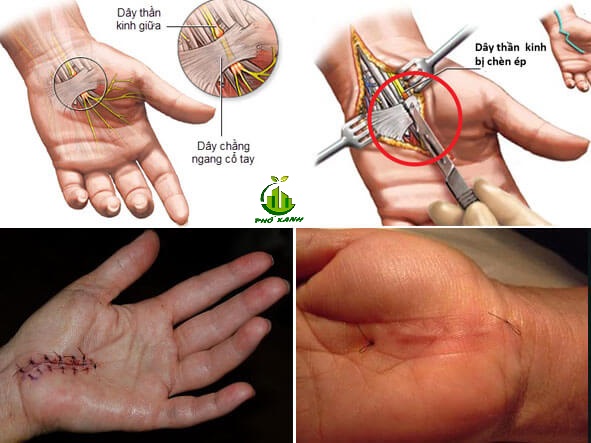 Hội chứng ống cổ tay