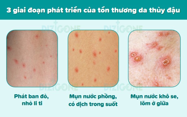 Bệnh thủy đậu - Nguyên nhân, Triệu chứng và Phương pháp Chẩn đoán