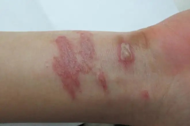Vết thương kiến ba khoang đốt