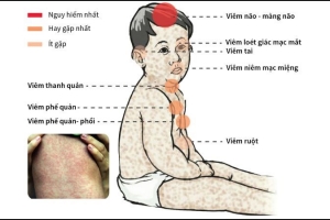 Nhận biết sớm các dấu hiệu bệnh sởi ở trẻ em?